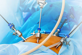 Minimally Invasive Surgery